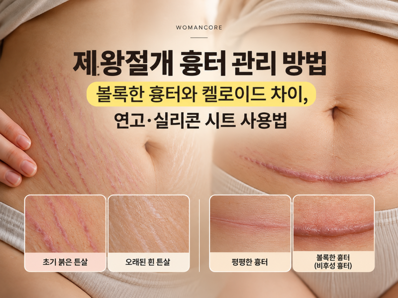 제왕절개 흉터 관리 방법｜볼록한 흉터와 켈로이드 차이, 연고·실리콘 시트 사용법
