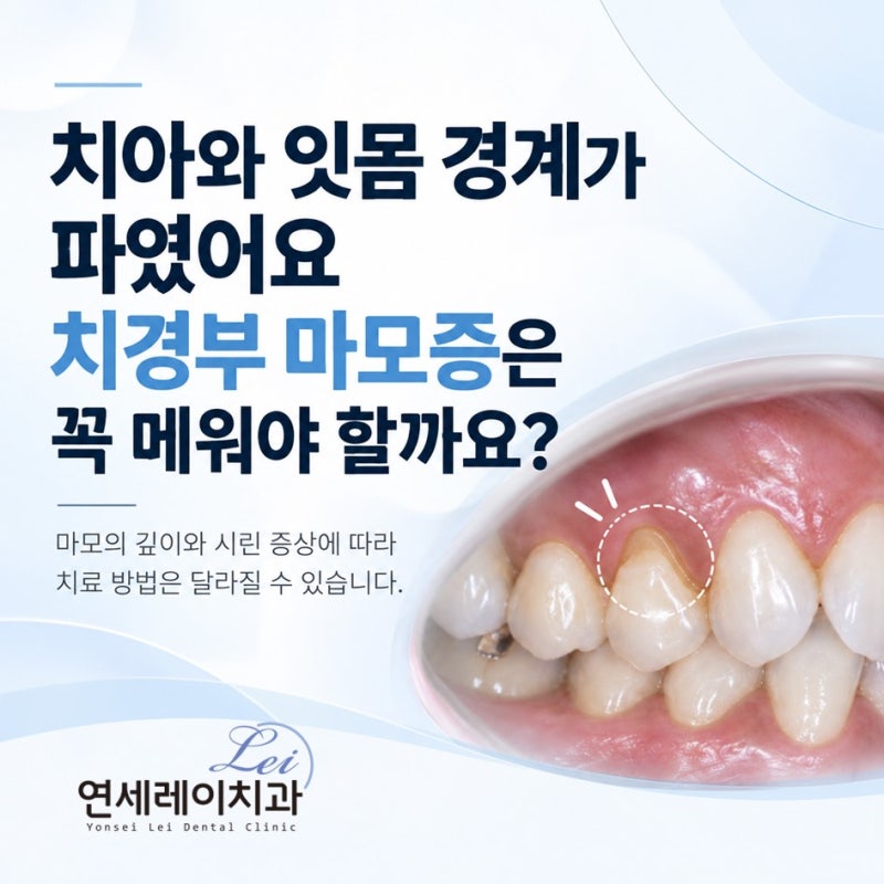 치아와 잇몸 경계가 파였어요, 치경부 마모증은 꼭 메워야 할까요?