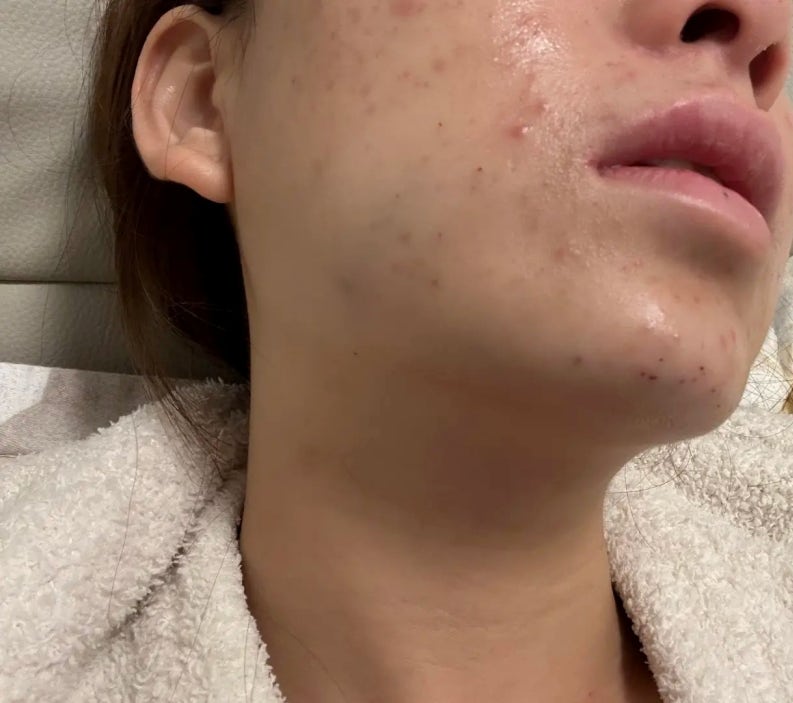 좁쌀여드름 피부영양제 끊고 여드름유산균으로 해결한 후기
