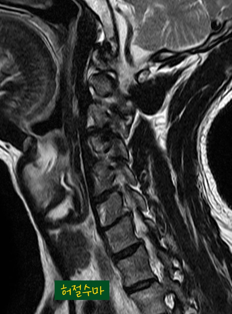 목디스크 탈출 파열 치료, MRI 검사가 반드시 필요한 이유