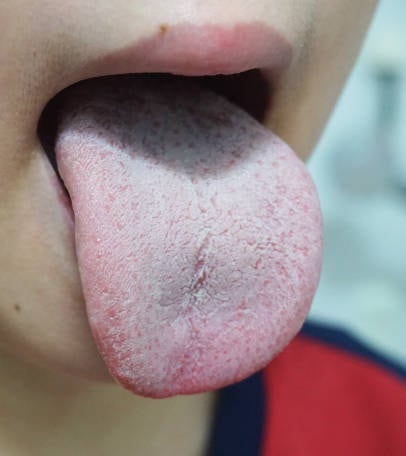 혓바닥 백태 긁어낼수록 심해졌어요