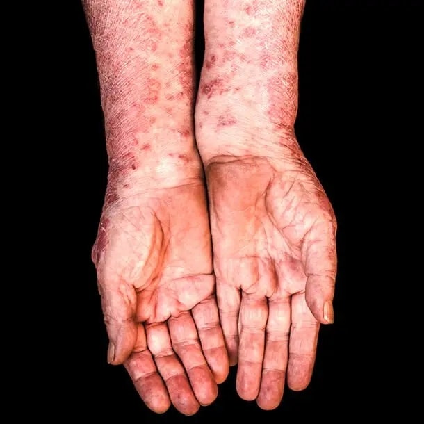 건선 Psoriasis, 건선관절염 Psoriatic Arthritis: 건선·건선관절염 의료진·의료기관·연구자 플랫폼