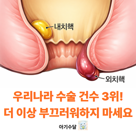 치질에는 무조건 '이 방법'입니다. 치질있는 사람은 반드시 OO을..더 이상 피똥싸지 마세요