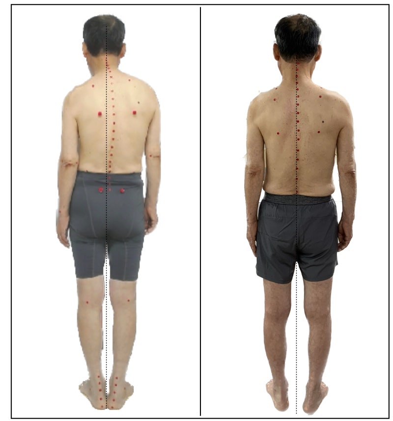 #0027 굽은등 때문에 비염이 심해지고 숨쉬기 힘든데, 자세 교정으로 나아질 수 있나요?