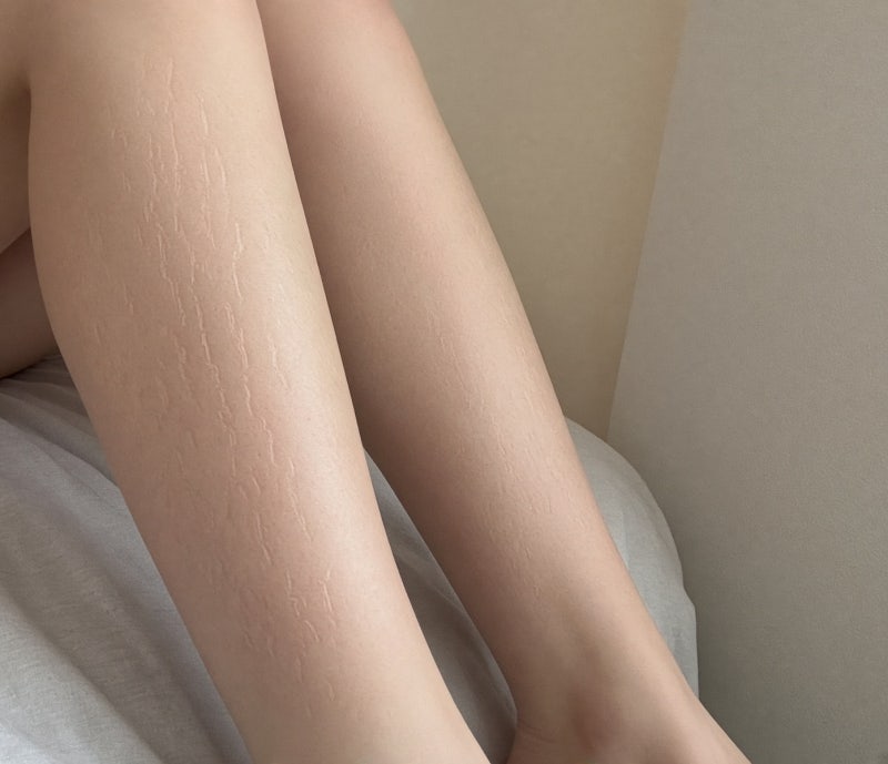 붉은튼살 골든타임 흰색튼살없애는법까지 파악