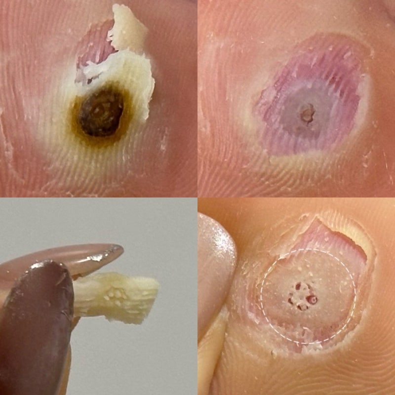 족저사마귀 치료 1편 엔드와츠 사과식초 뿌리뽑기