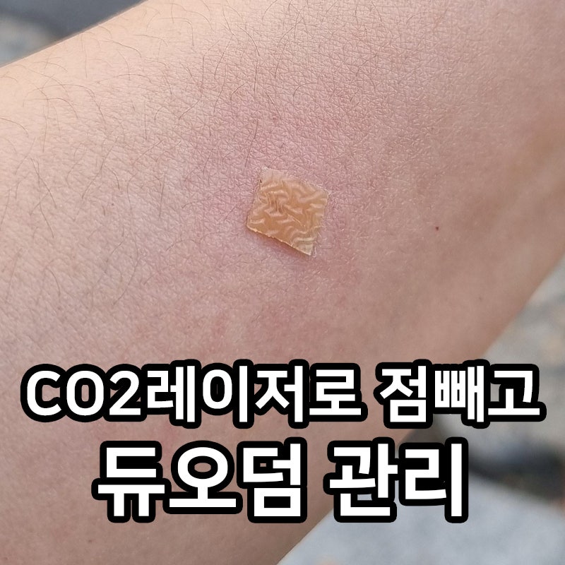 CO2 레이저로 점 빼고 듀오덤으로 관리