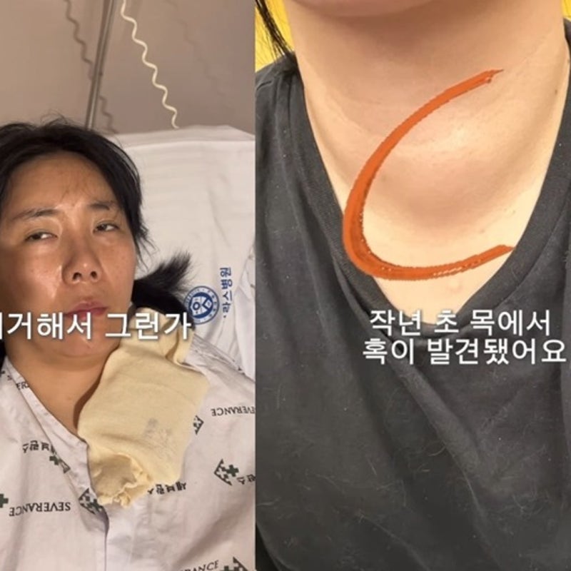 갑상선 4분의 3 절제한 허안나 "누워 있어도 피곤"… 수술 후 근황 고백
