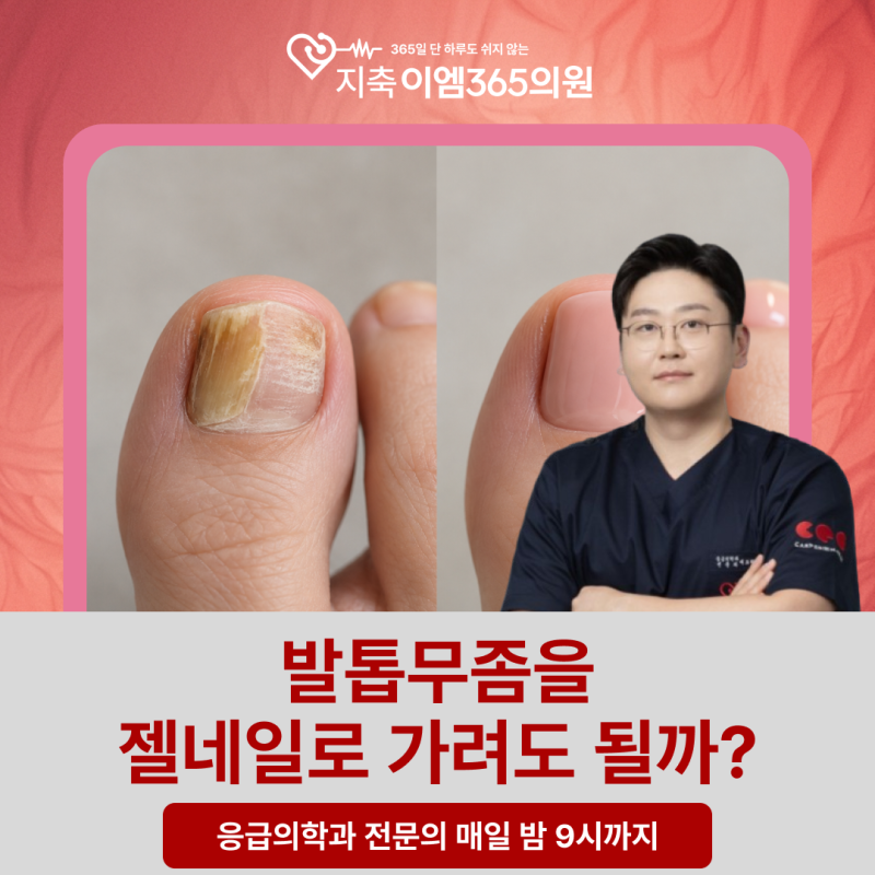 지축 삼송 발톱무좀, 젤네일로 가려도 괜찮을까요?