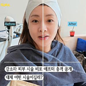 강소라 피부 시술 충격적인 비포 애프터 "돈을 안 쓸 수가 없네"