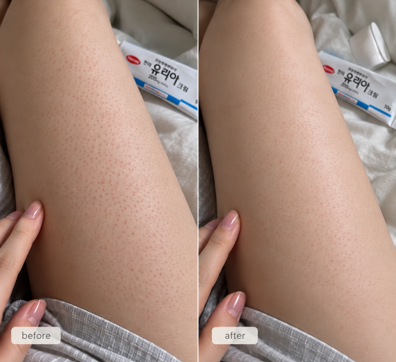 한미 유리아크림 모공각화증 발뒤꿈치 각질에 어떻게 바를까