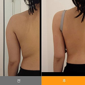 등, 팔뚝 무한람스 당일 후기｜람스 당일 과정과 통증, 멍, 일상 복귀 기간, 가격까지