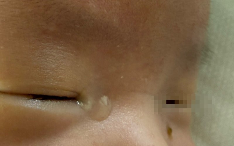 신생아 눈물고임·눈곱, 안과 진료 후 알게 된 진짜 눈물샘 마사지 방법 (동아오젝스 처방 후....