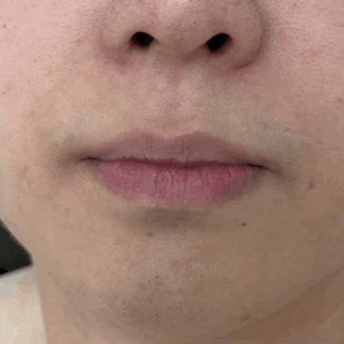[유라이크 한달 사용 후기] 사파이어쿨링 X2 내돈내산 | 남자 수염 제모의 중요성 | 제모 비포 ....