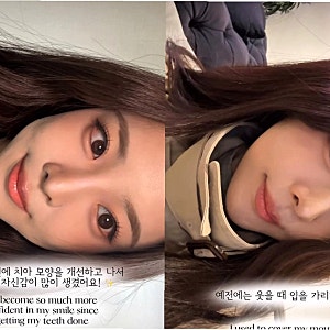 미스코리아 진 우서윤, 치아 개선으로 자신감 되찾은 스토리