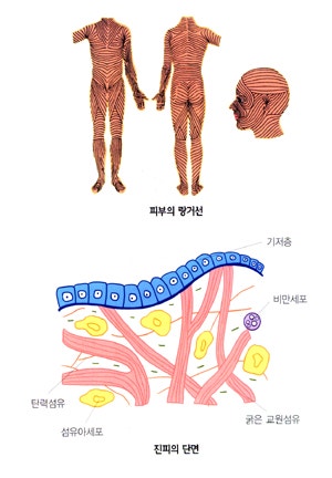 피부의 조직구 육종